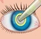 Cirurgia de olhos