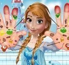 Mãos machucaas da Frozen Anna